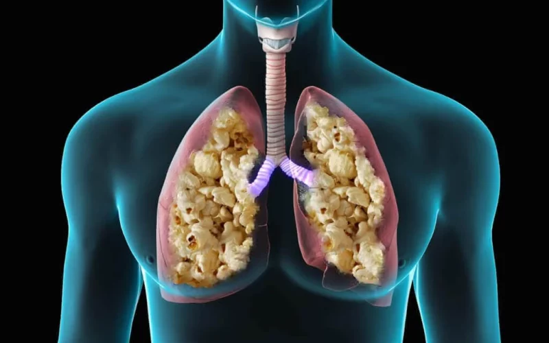 Popcorn Lung