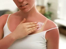 Sun Allergies