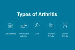 Running and Arthritis