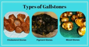 Diet and Gallstones