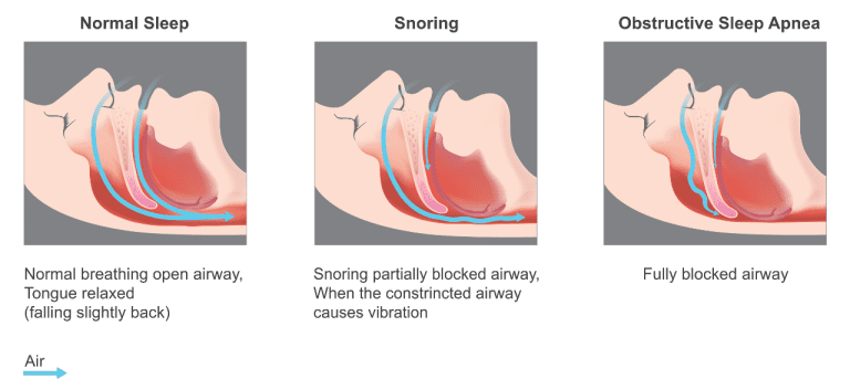 You Should Know: How Sleep Apnea Hurts Bones and Teeth