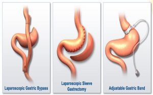 Weight Loss Surgery & Alcohol