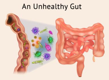 Unhealthy Gut