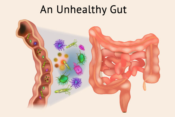 Unhealthy Gut