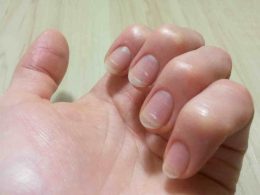 White Spots on Your Nails