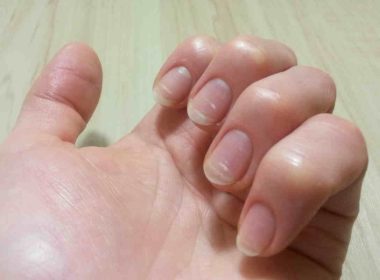 White Spots on Your Nails