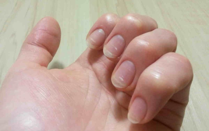 White Spots on Your Nails