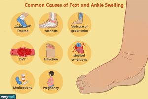 Ankle Inflammation