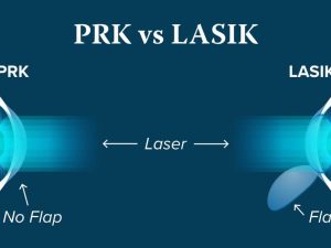 PRK vs LASIK