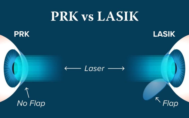 PRK vs LASIK