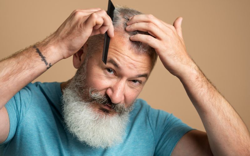 Androgenetic Alopecia
