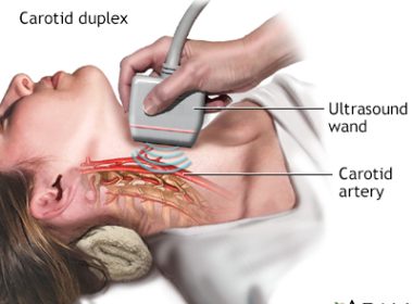CAROTID ARTERY SCAN