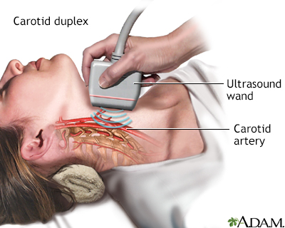 CAROTID ARTERY SCAN