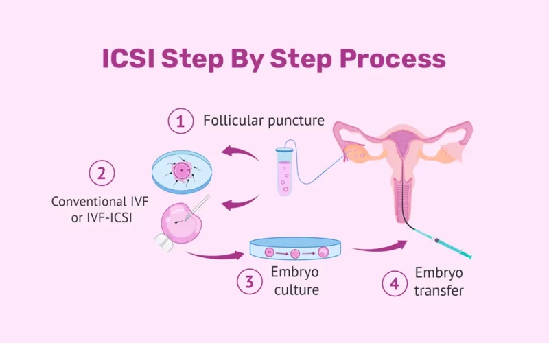 Advanced ICSI Treatment for Infertility in Delhi – Leading Clinics, Competitive Pricing, and Authentic Success Stories