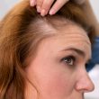 Scarring Alopecia