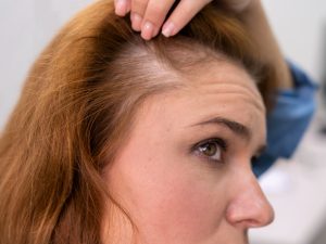 Scarring Alopecia
