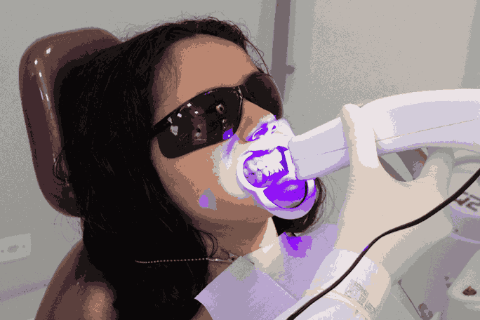 LED teeth whitening