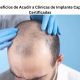 Beneficios de Acudir a Clínicas de Implante Capilar Certificadas