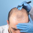 Hair Implant