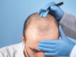 Hair Implant