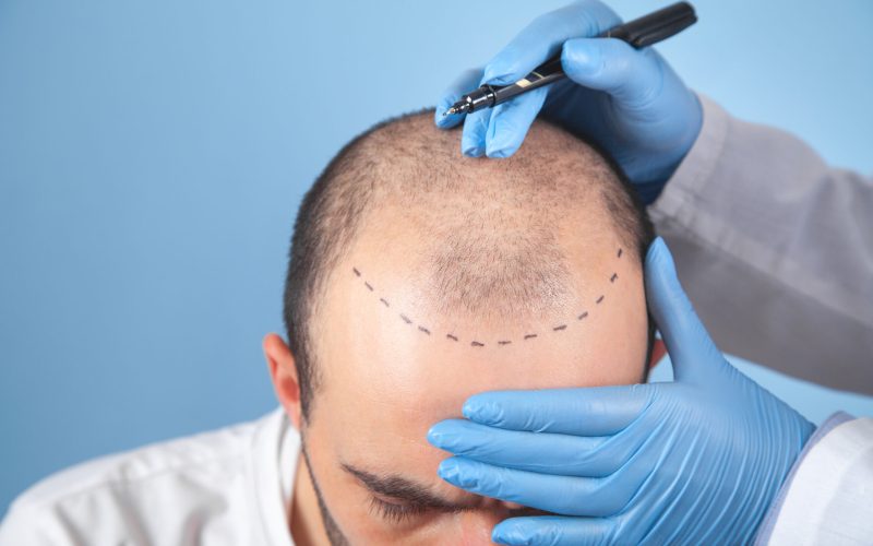Hair Implant