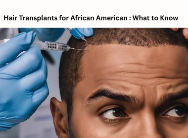 Hair Transplants for African American : What to Know