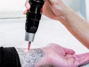 laser tattoo removal in islamabad
