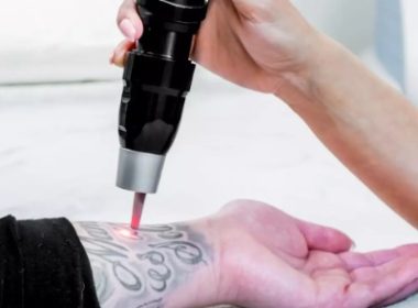 laser tattoo removal in islamabad