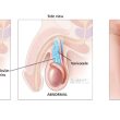 varicocele testicular