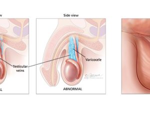 varicocele testicular
