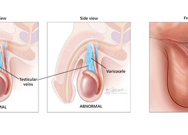 varicocele testicular