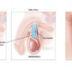 varicocele testicular
