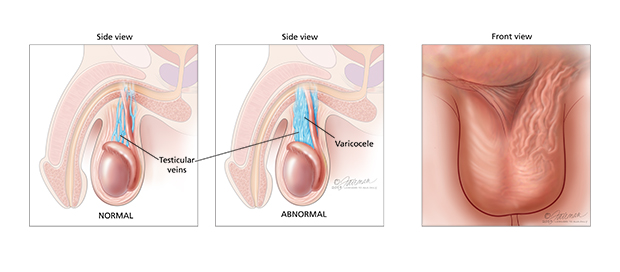 varicocele testicular