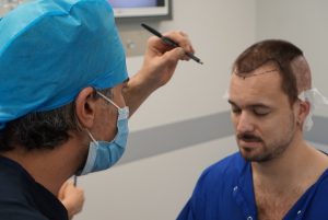 Hair Implant