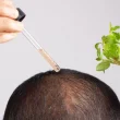 prp hair treatment in islamabad (1)