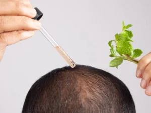 prp hair treatment in islamabad (1)