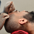 The Ultimate Hair Transplant Aftercare Routine