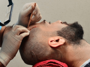 The Ultimate Hair Transplant Aftercare Routine