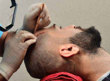 The Ultimate Hair Transplant Aftercare Routine