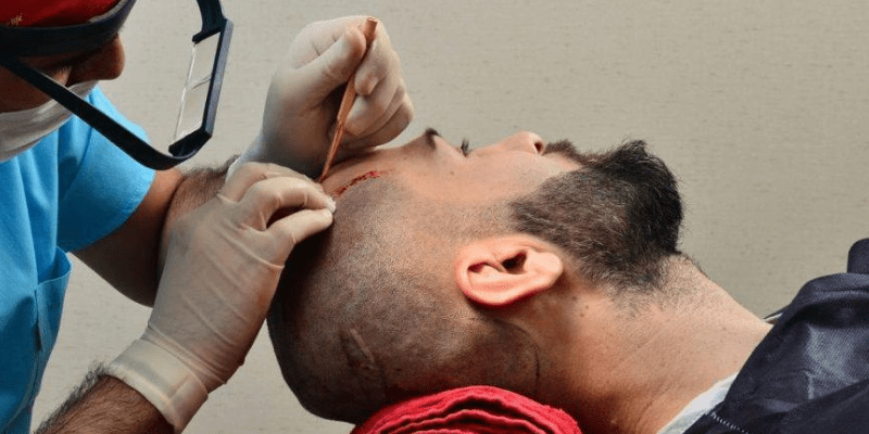 The Ultimate Hair Transplant Aftercare Routine