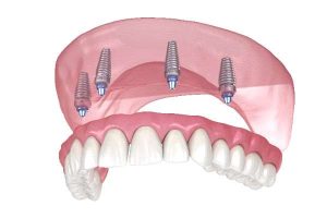 Implant