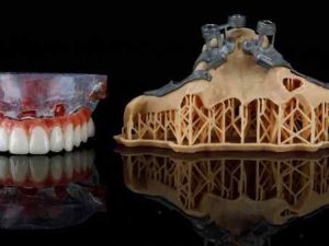 implant