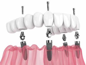 Implant