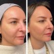 Mesotherapy in dubai