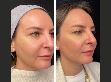 Mesotherapy in dubai