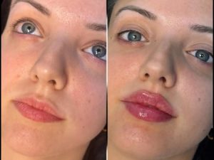 Fillers in Dubai