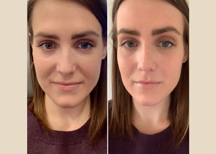 Prp Treatment in Dubai