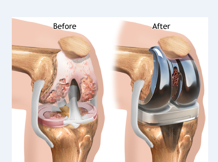 Best knee replacement surgeon in Delhi