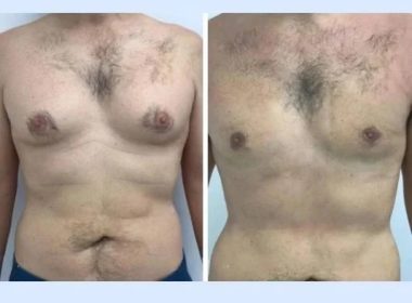 Gynecomastia Surgery in dubai