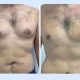 Gynecomastia Surgery in dubai